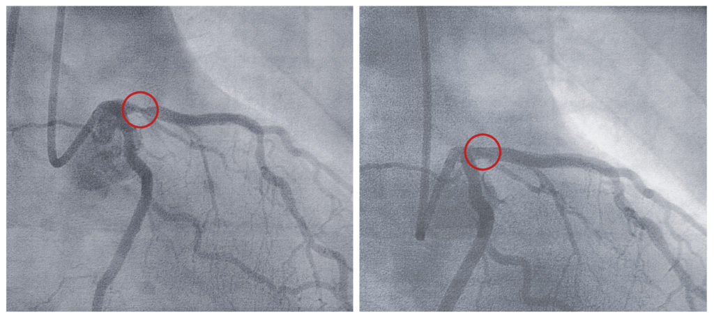 Angiogram The Johns Hopkins Patient Guide To Diabetes