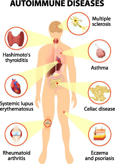 Autoimmune disease - The Johns Hopkins Patient Guide to Diabetes