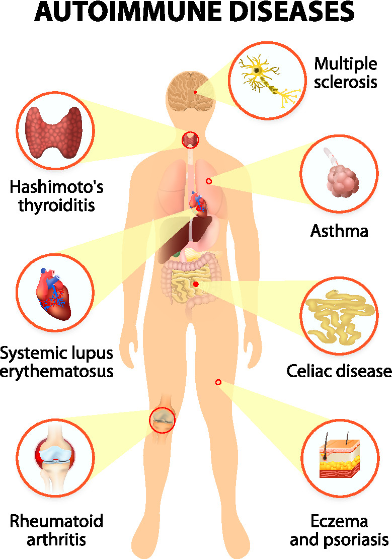 Autoimmune disease   The Johns Hopkins Patient Guide to Diabetes