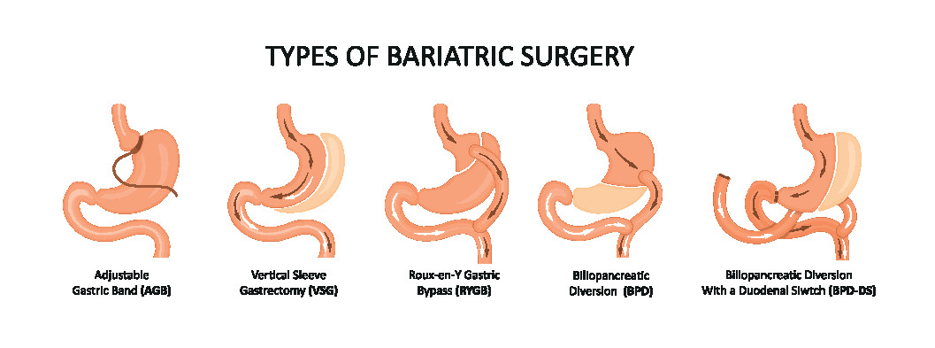 Bariatric surgery - The Johns Hopkins Patient Guide to Diabetes