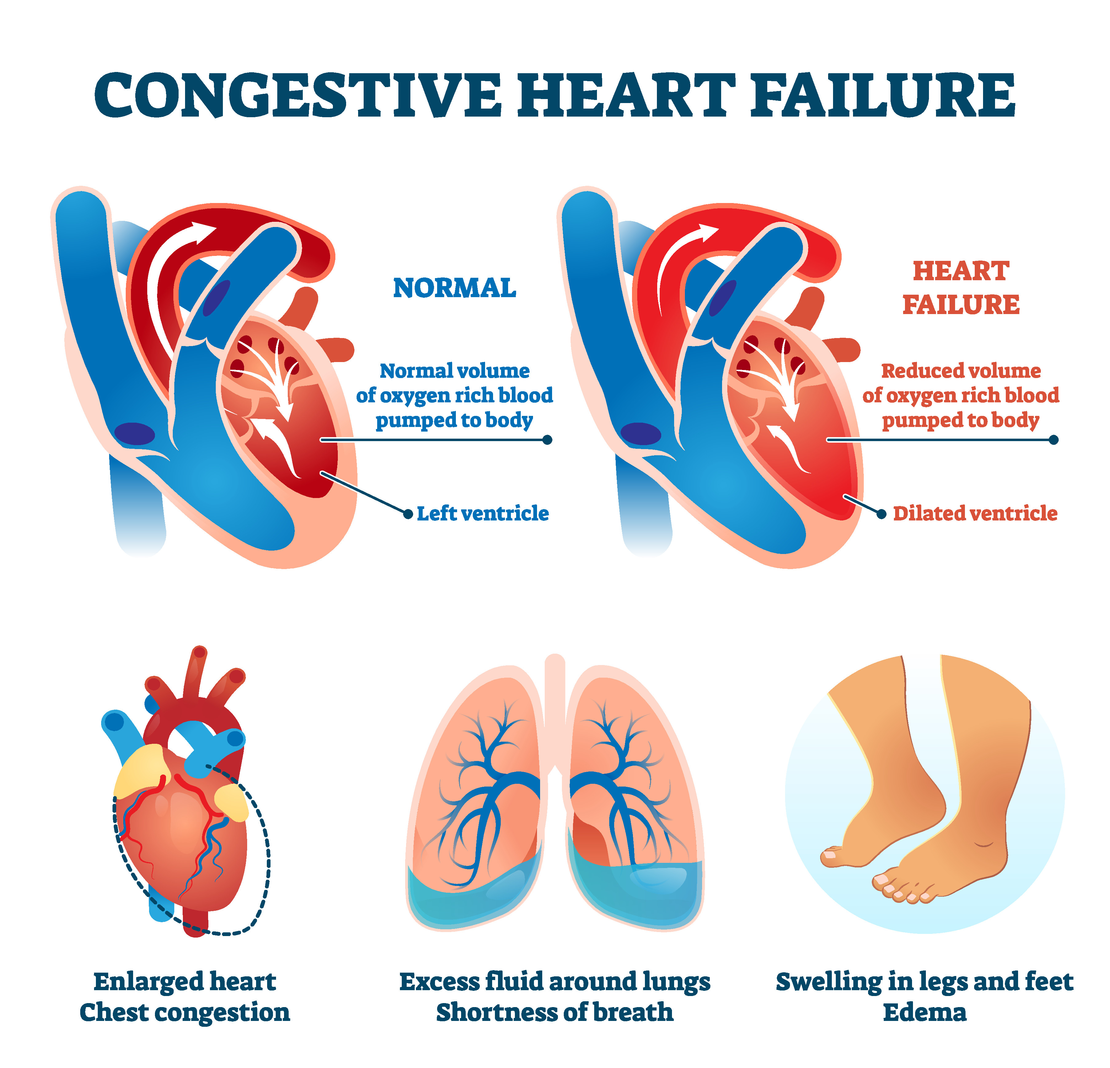what causes congestive heart failure