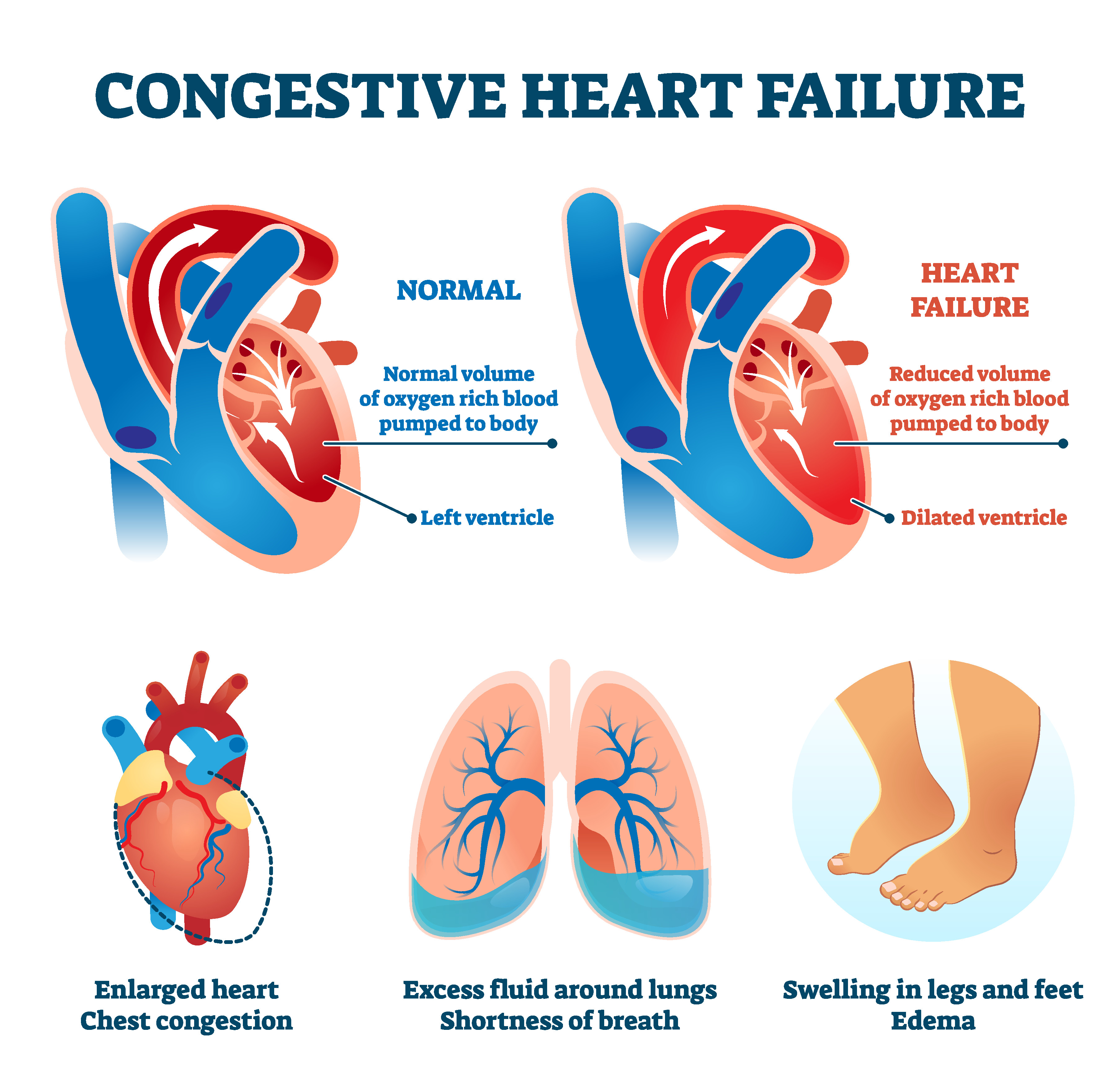 Поражением сердца с застойной сердечной недостаточностью. Heart failure. Congestive Heart failure. Сердечная недостаточность ногти. Острая сердечная недостаточность вектор.