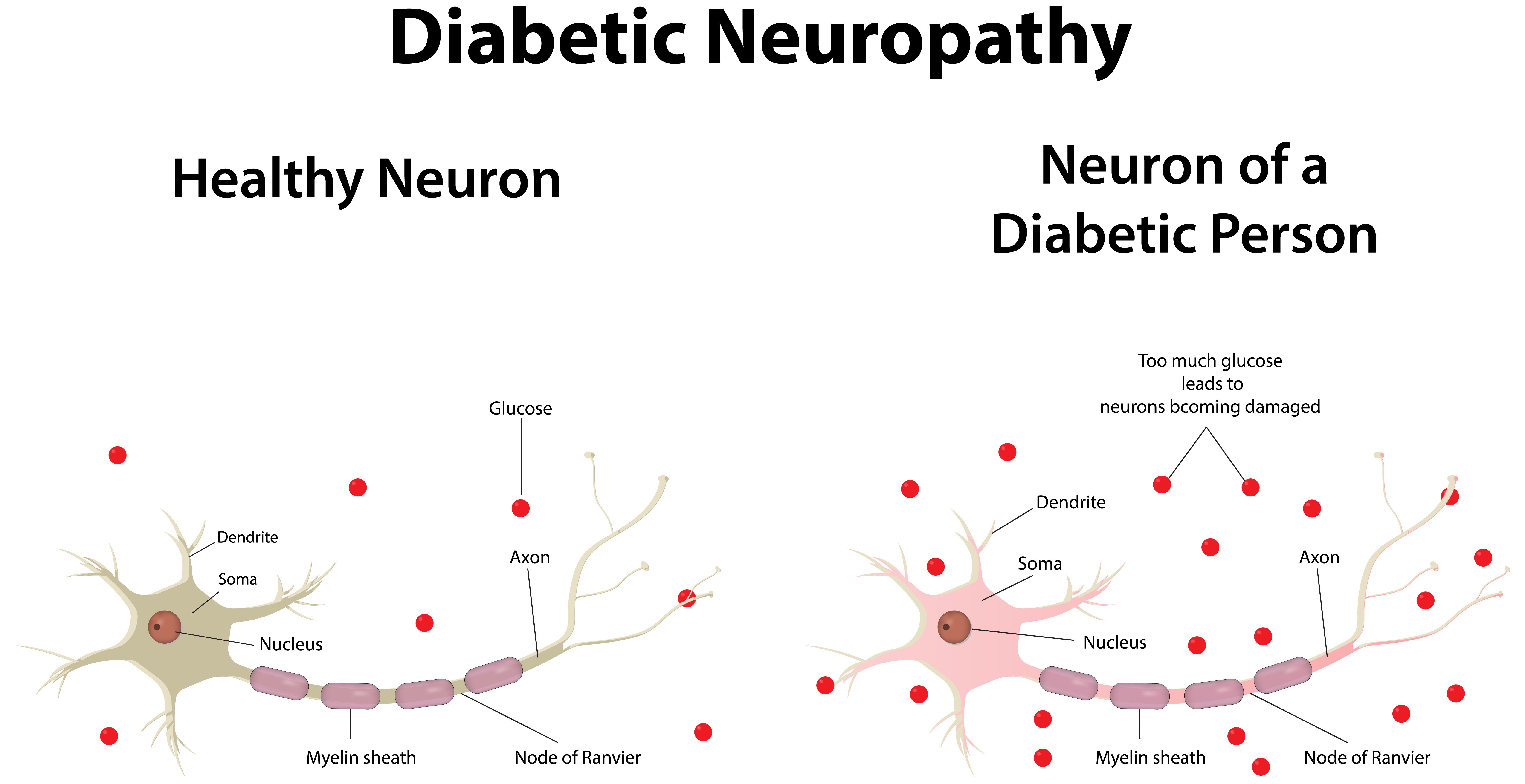 Diabetic Neuropathy The Johns Hopkins Patient Guide To Diabetes